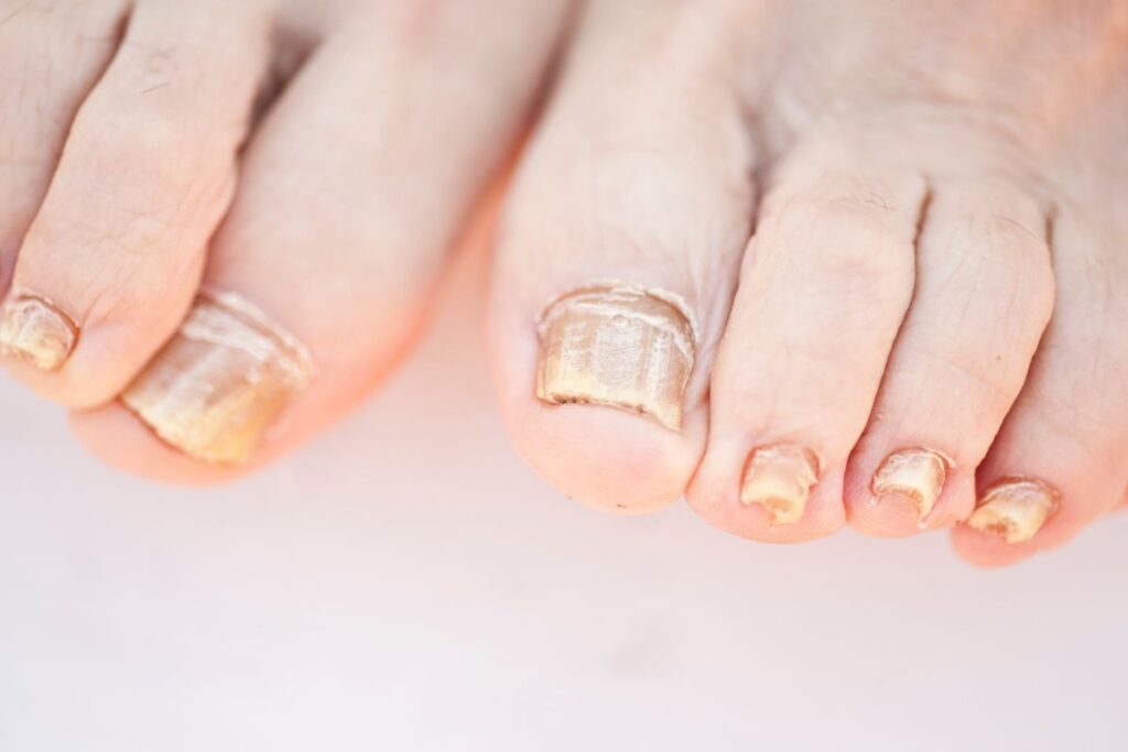 Fungos nas unhas: cuidados simples que fazem toda a diferença